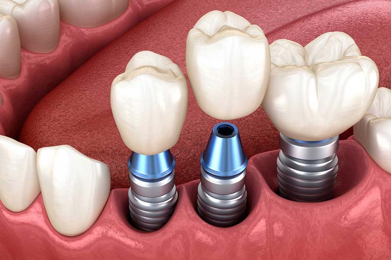 قیمت ایمپلنت دیجیتال چند است؟